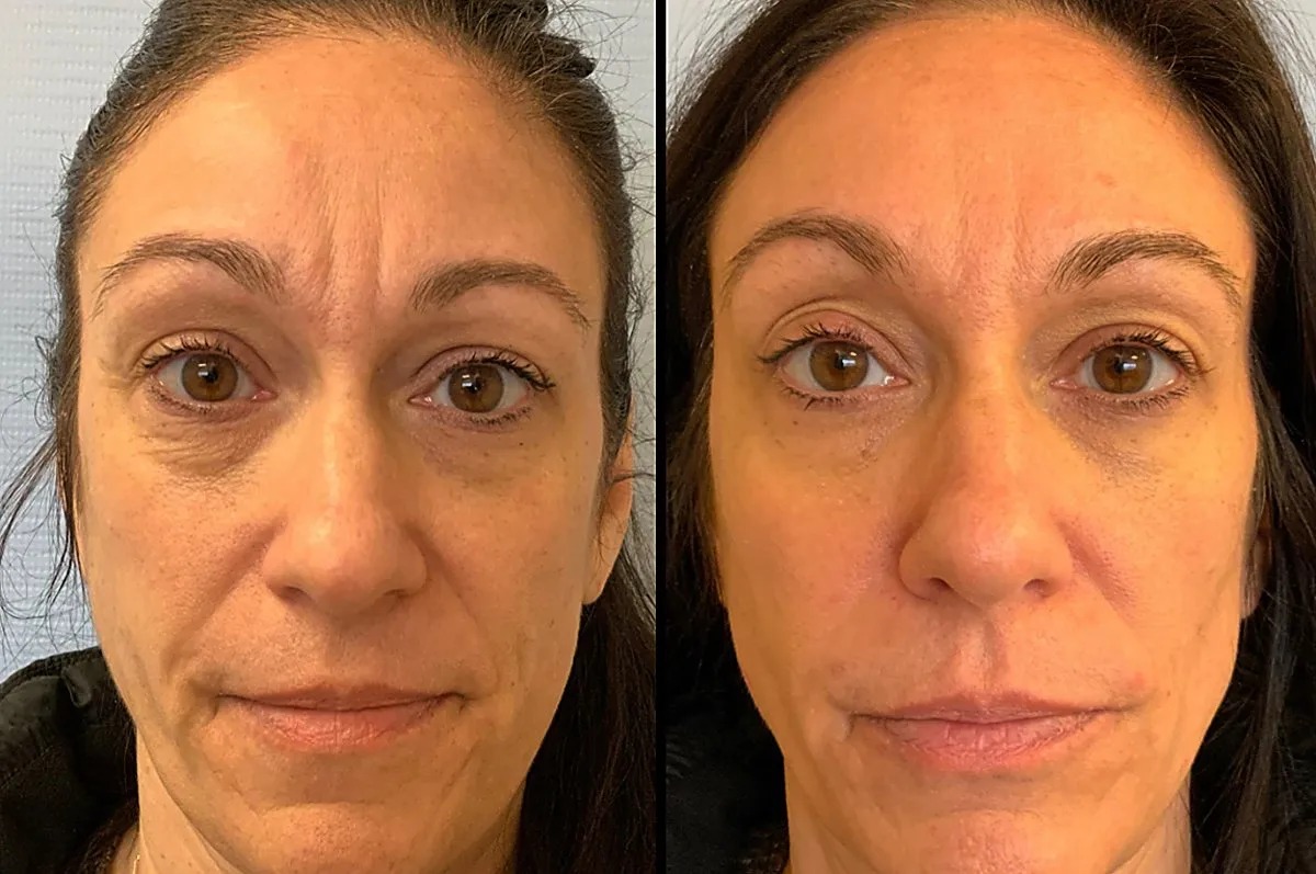 Xeomin Treatment Results