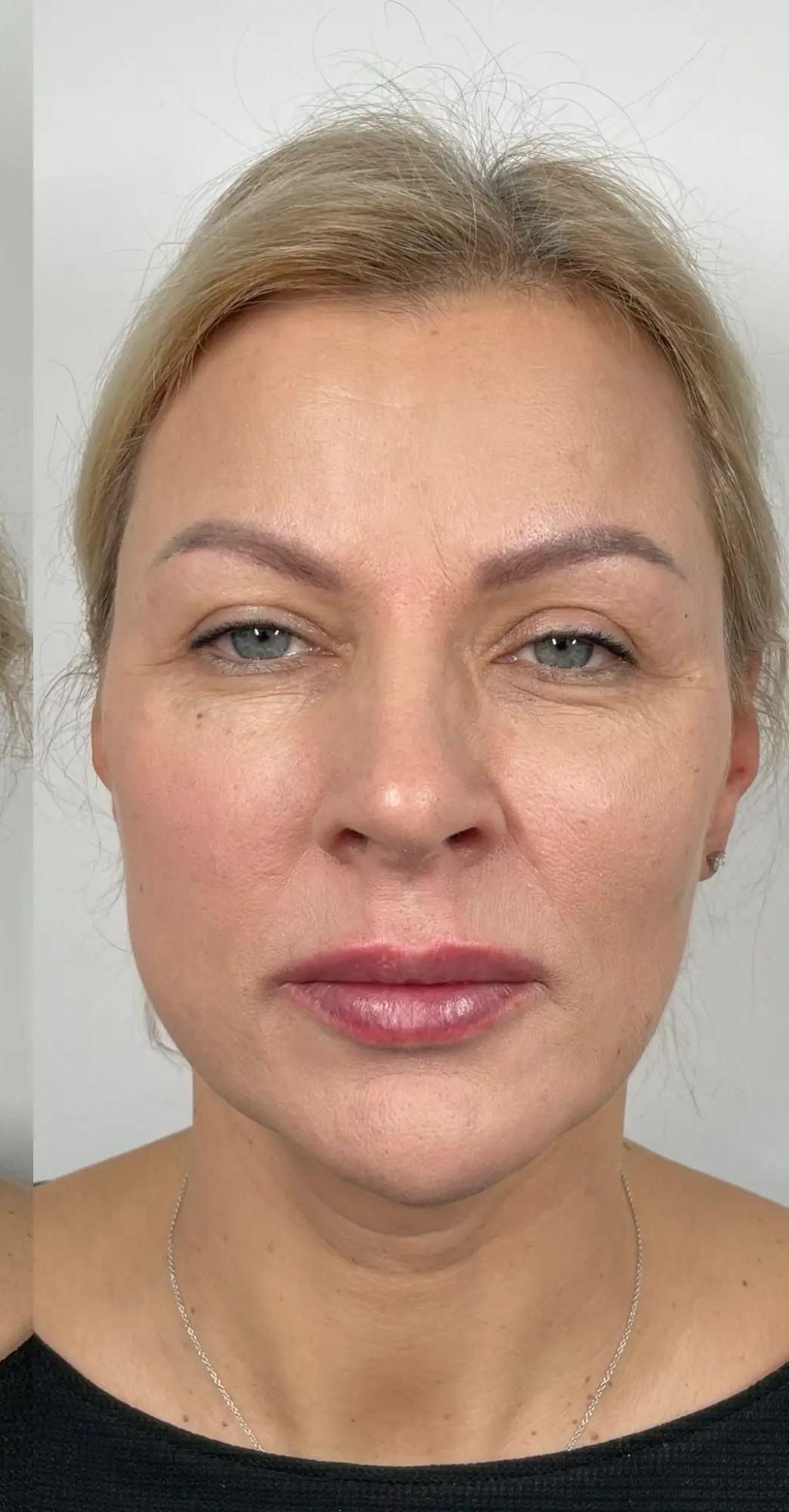 After Botox Treatment